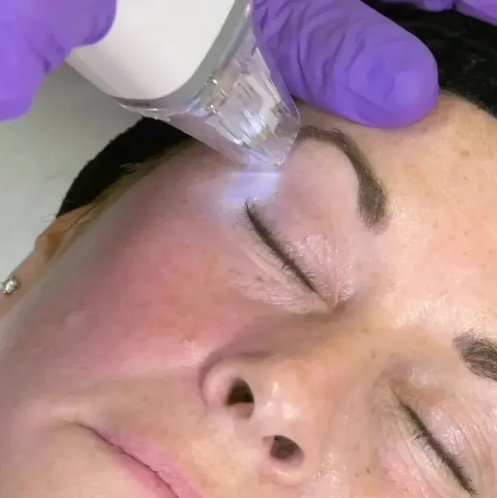 RF Microneedling Meso